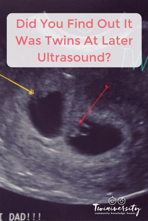 twins missed at dating scan